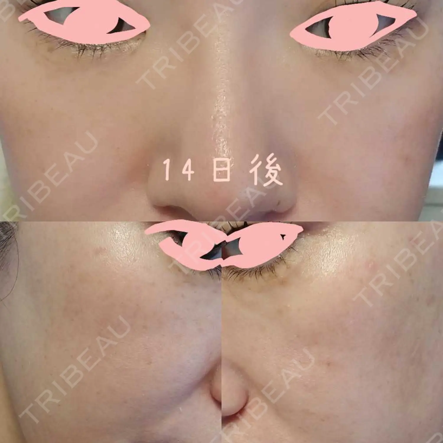 施術後の写真
