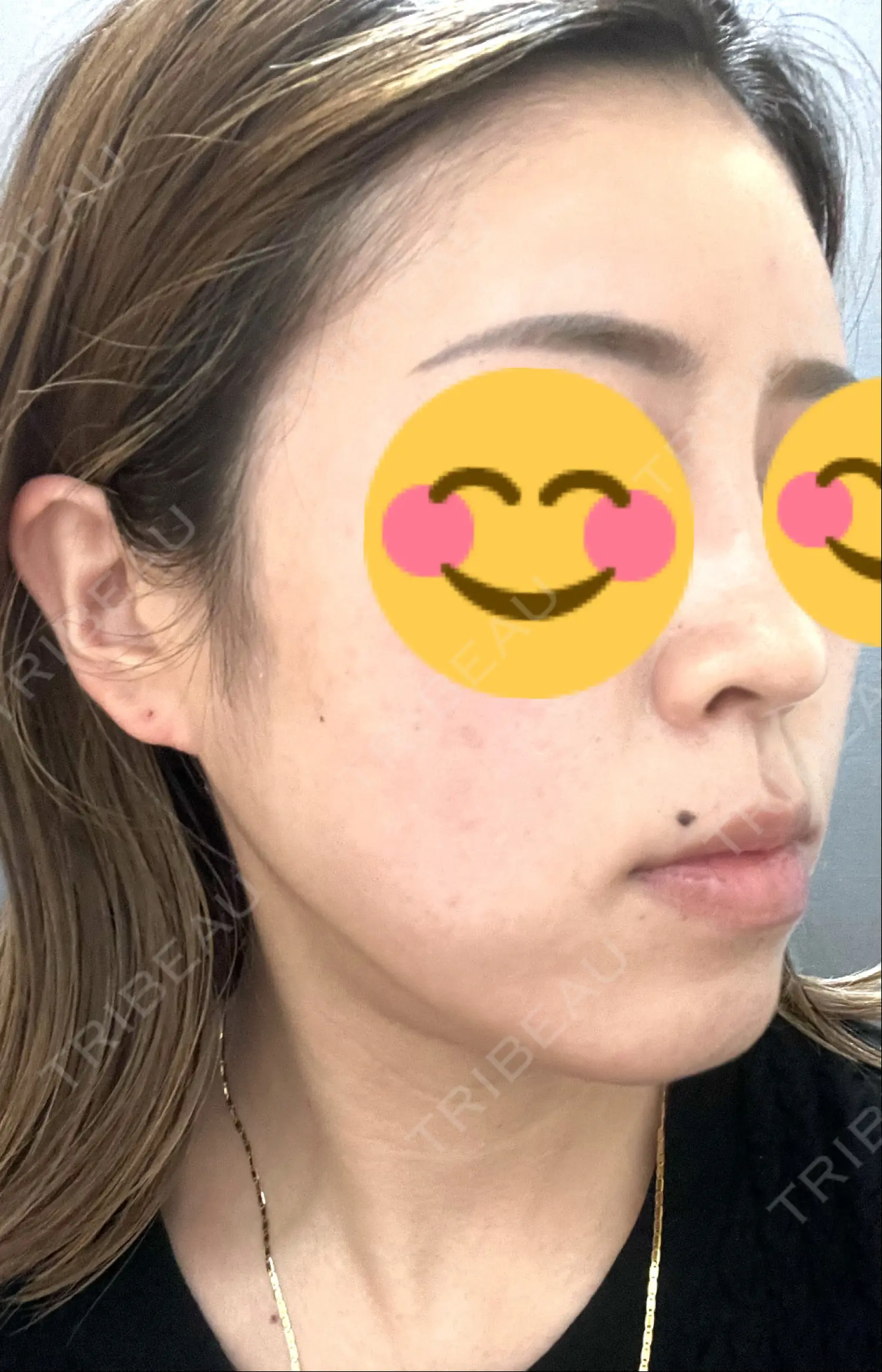 施術後の写真