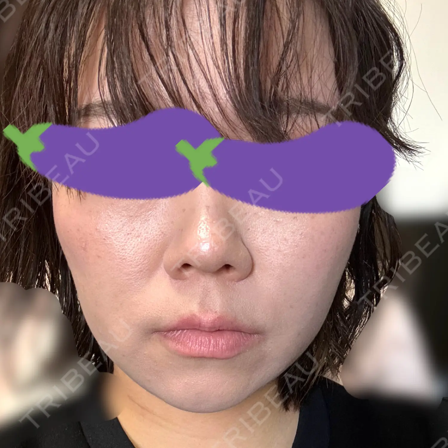 施術後の写真