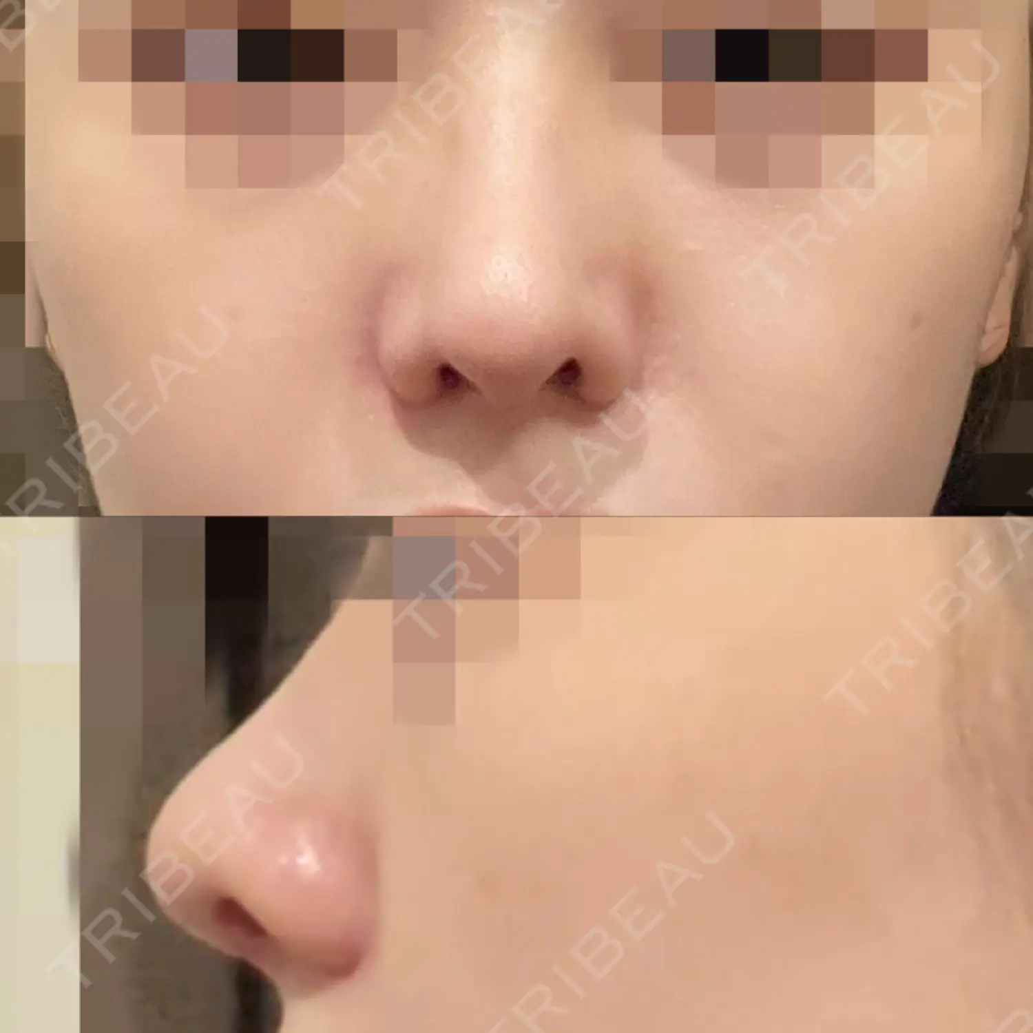施術後の写真