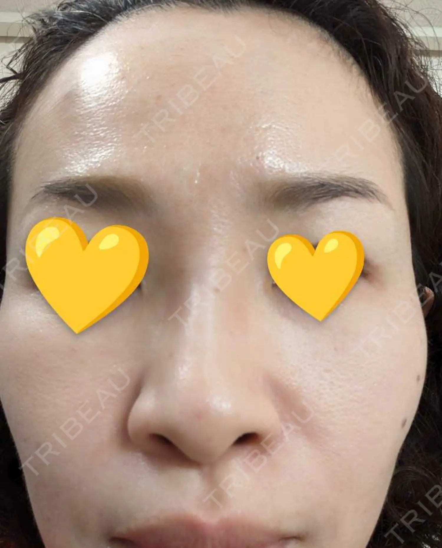 施術後の写真