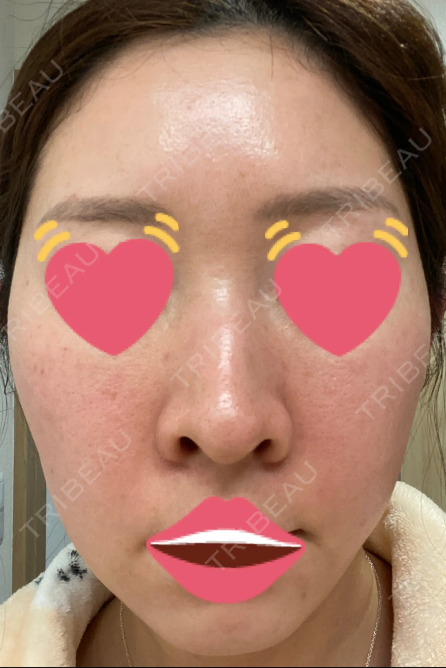 施術後の写真