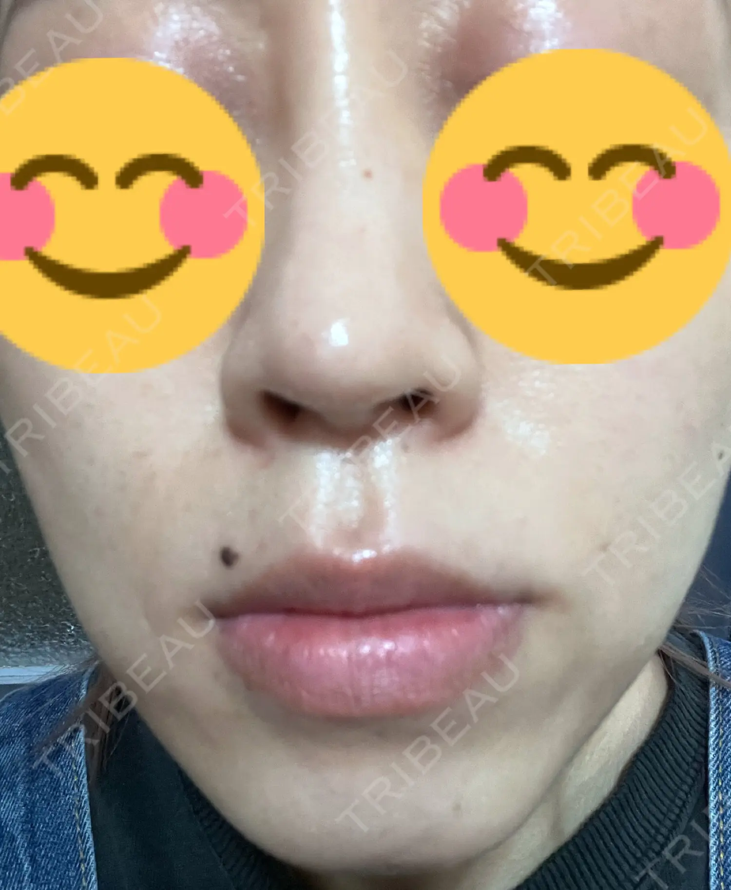 施術後の写真