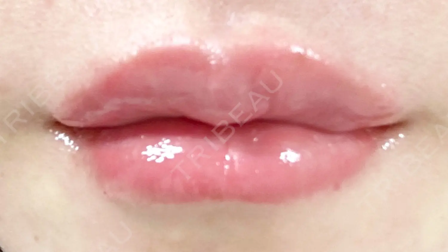 施術後の写真