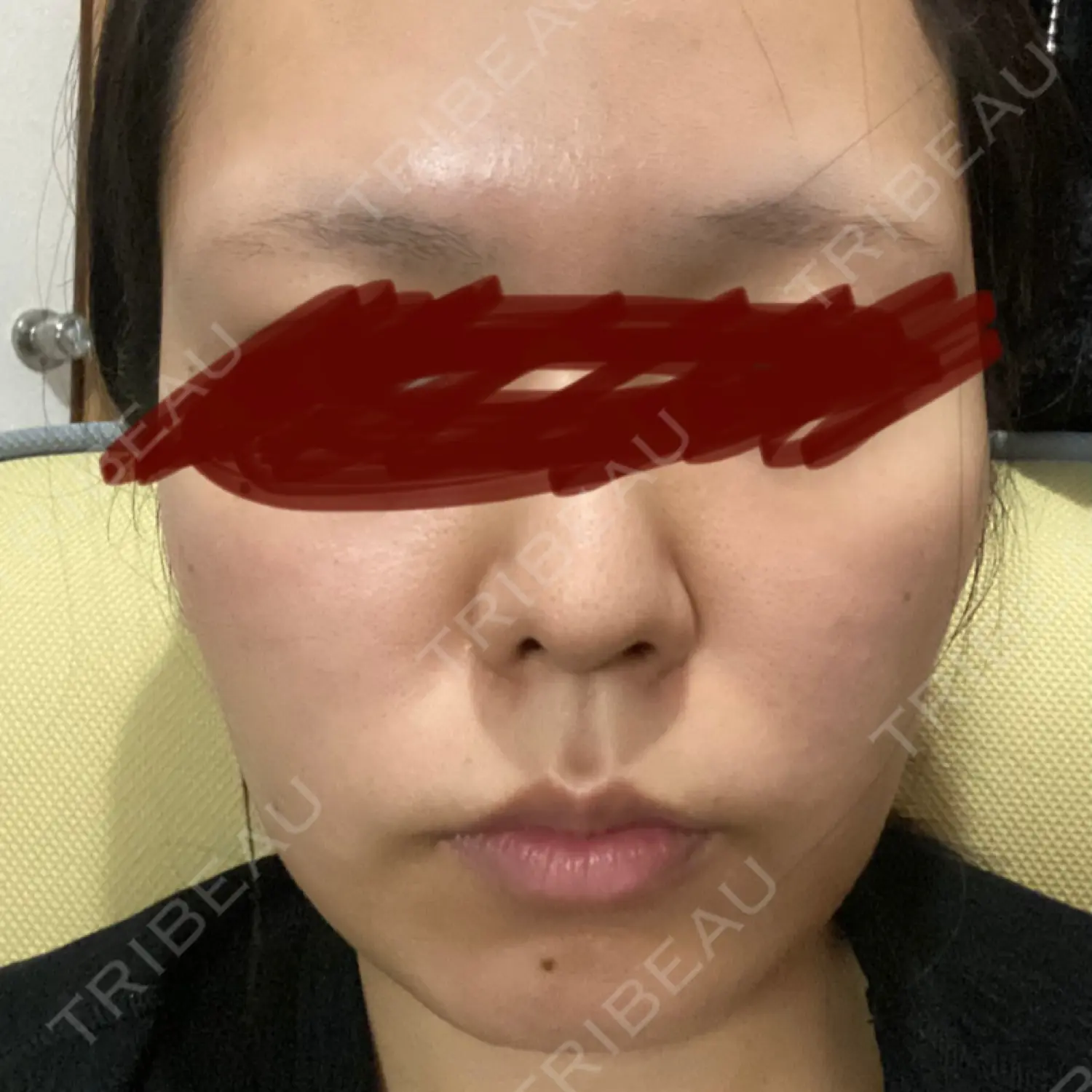 施術後の写真