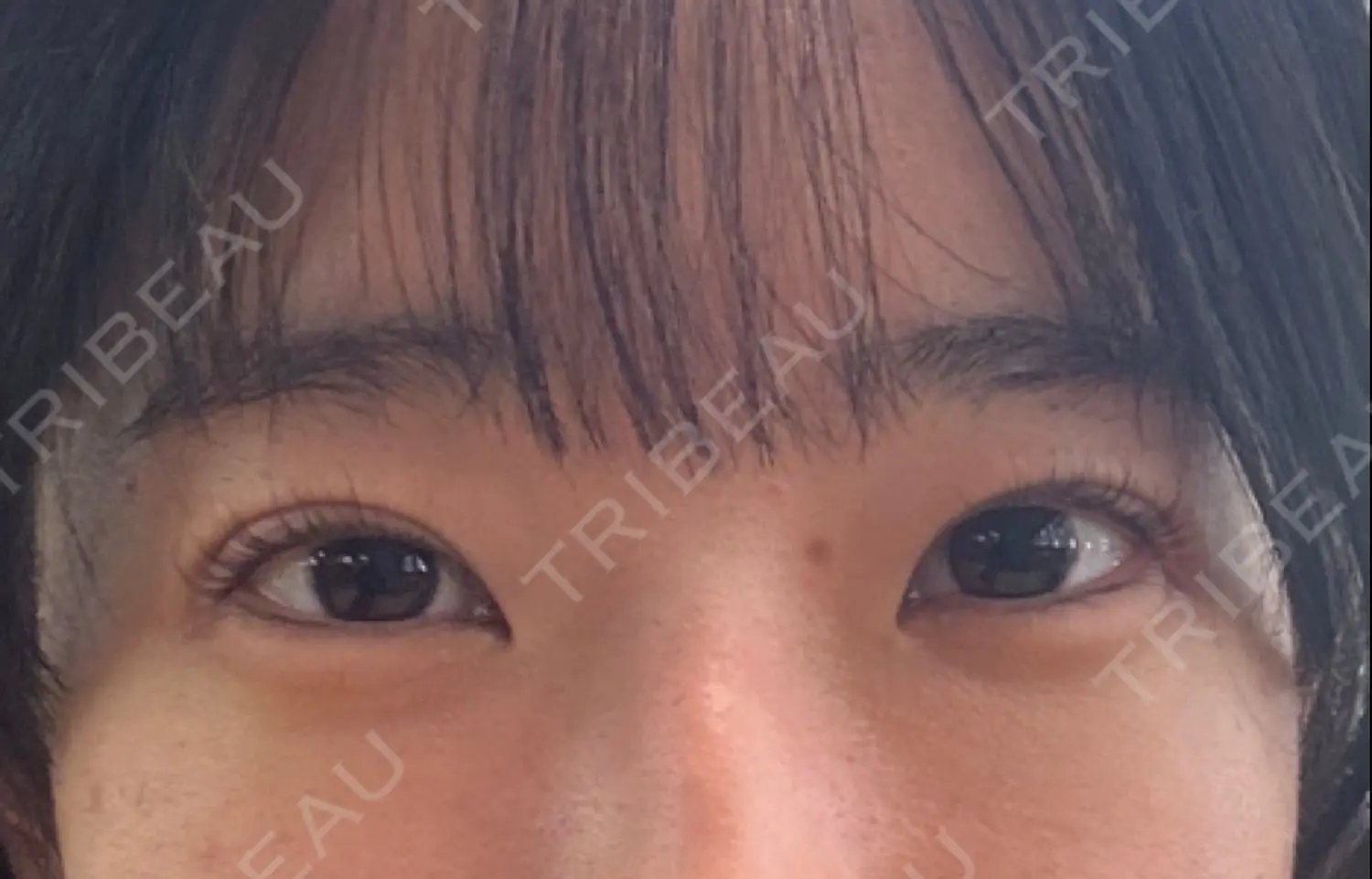 施術後の写真