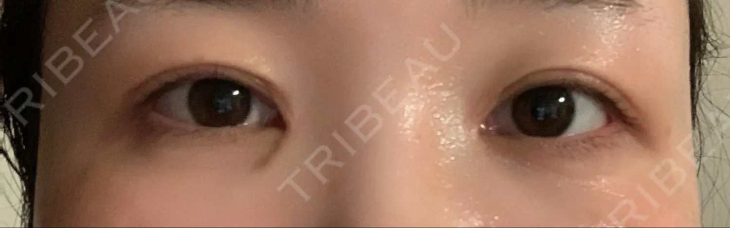 施術後の写真