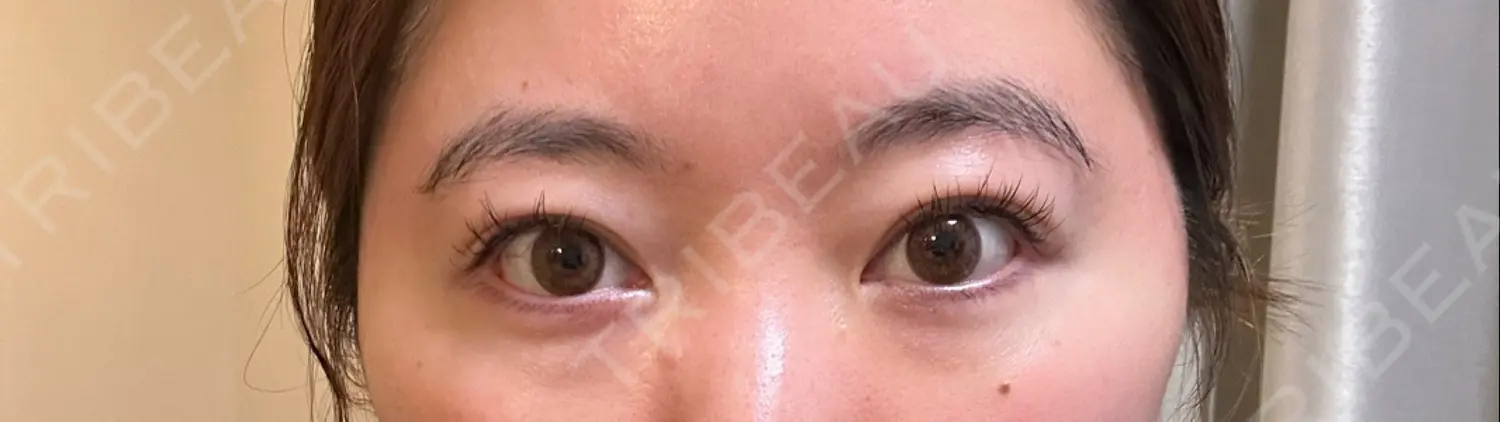 施術後の写真