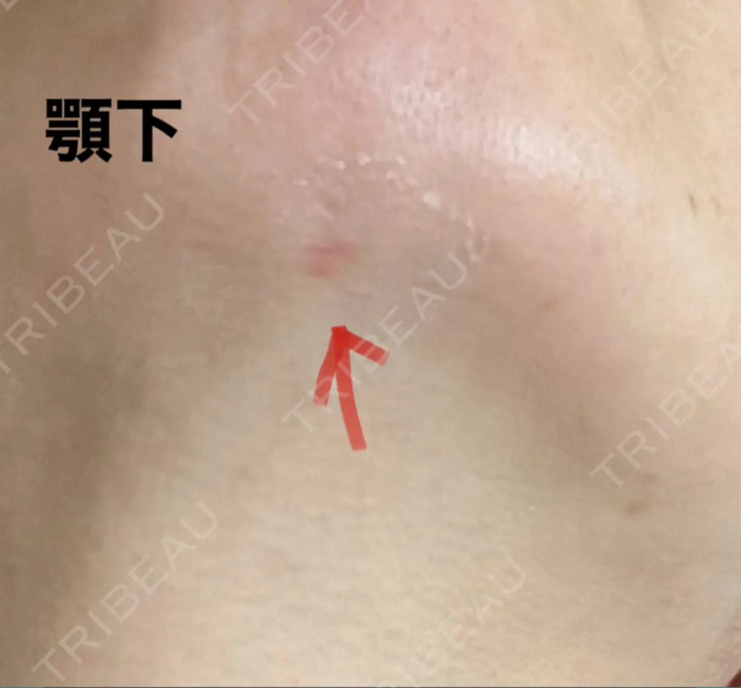 施術後の写真