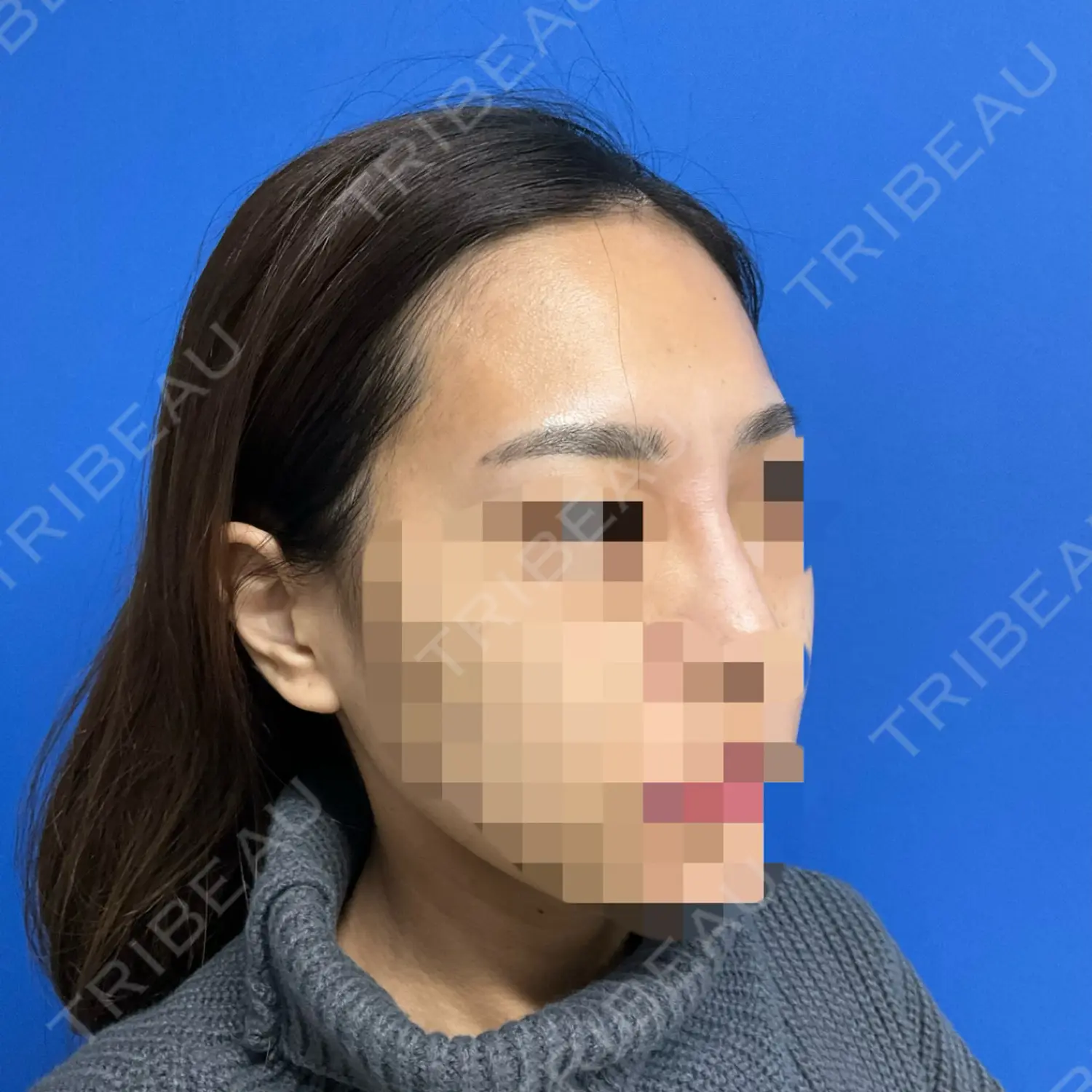施術後の写真