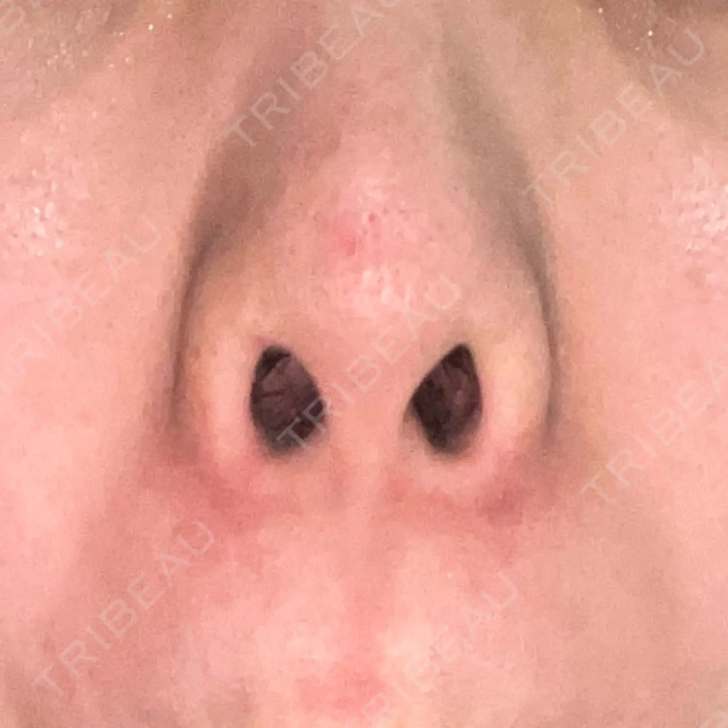 施術後の写真