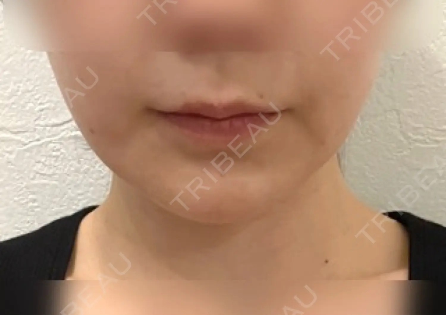 施術後の写真