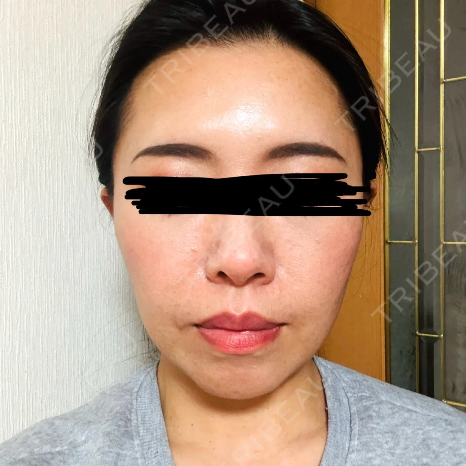 施術後の写真