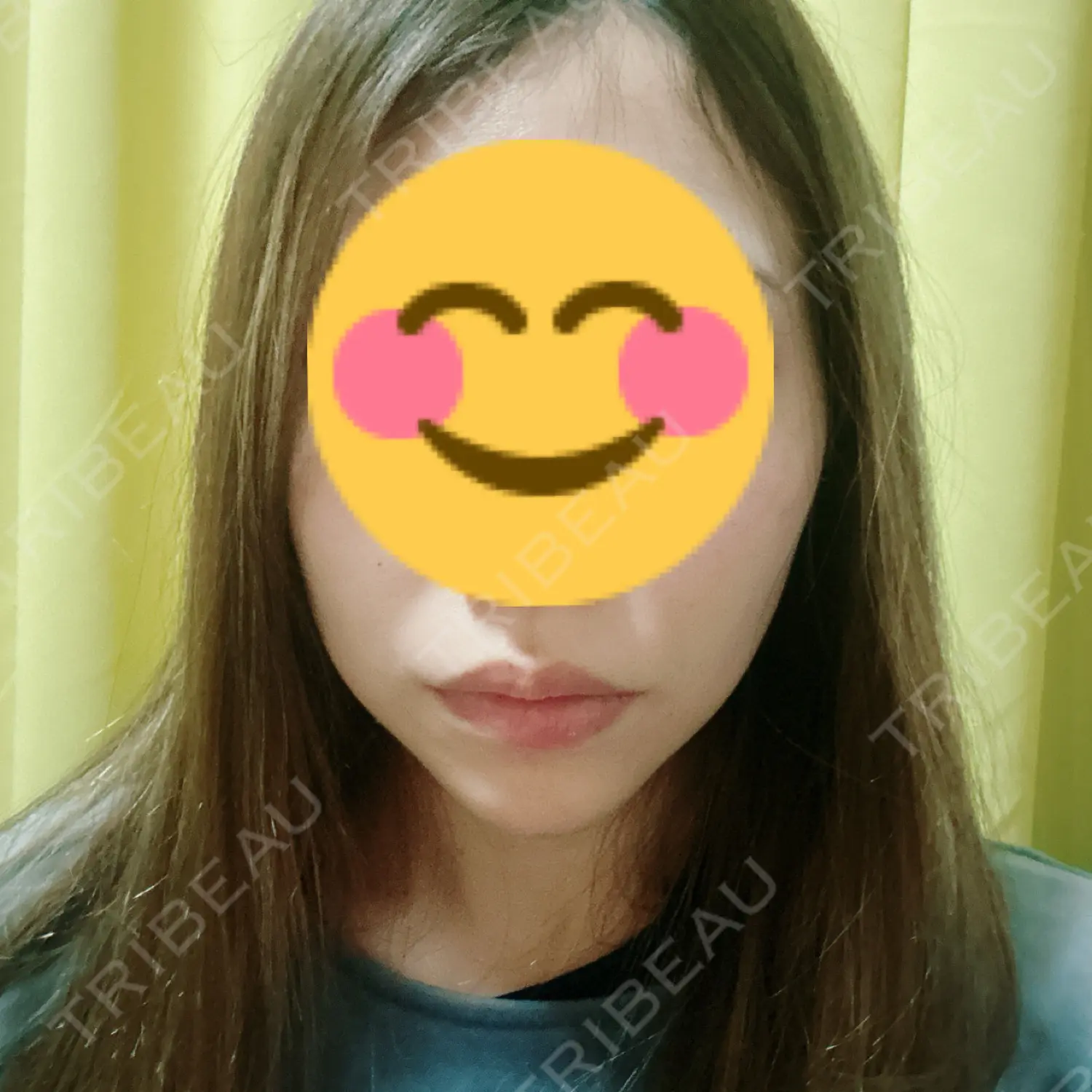 施術後の写真