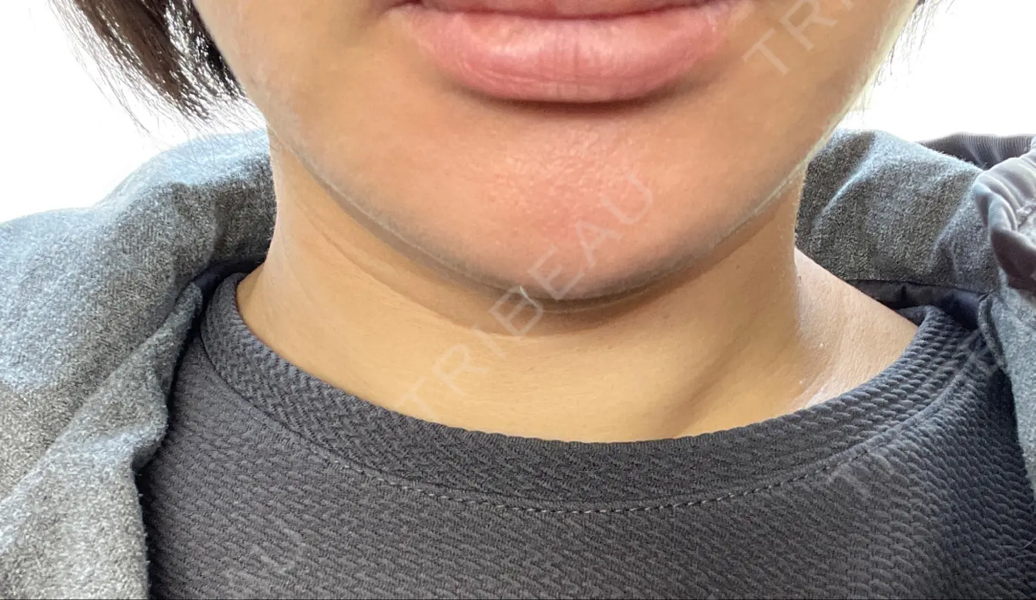 施術後の写真