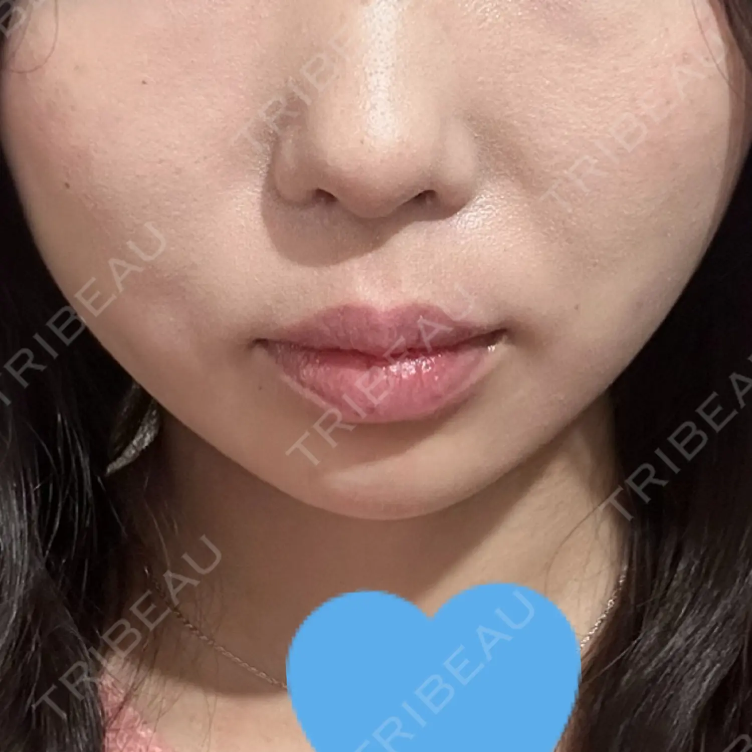 施術後の写真