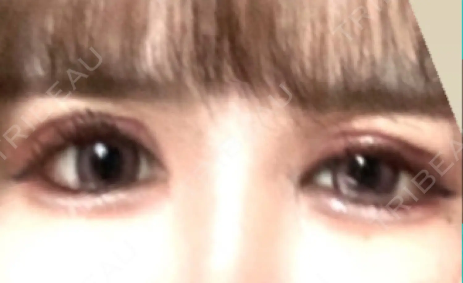 施術後の写真