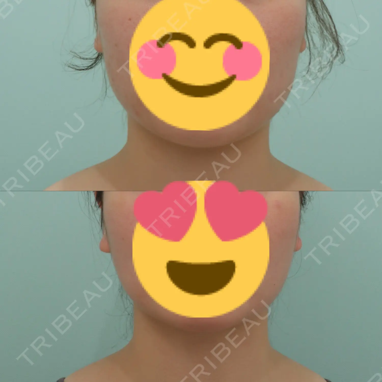 施術後の写真