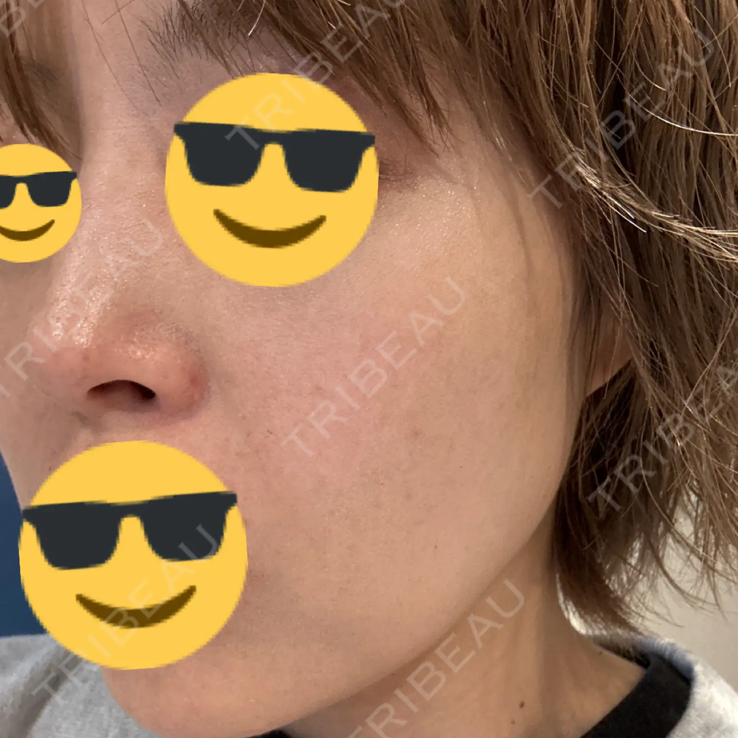 施術後の写真