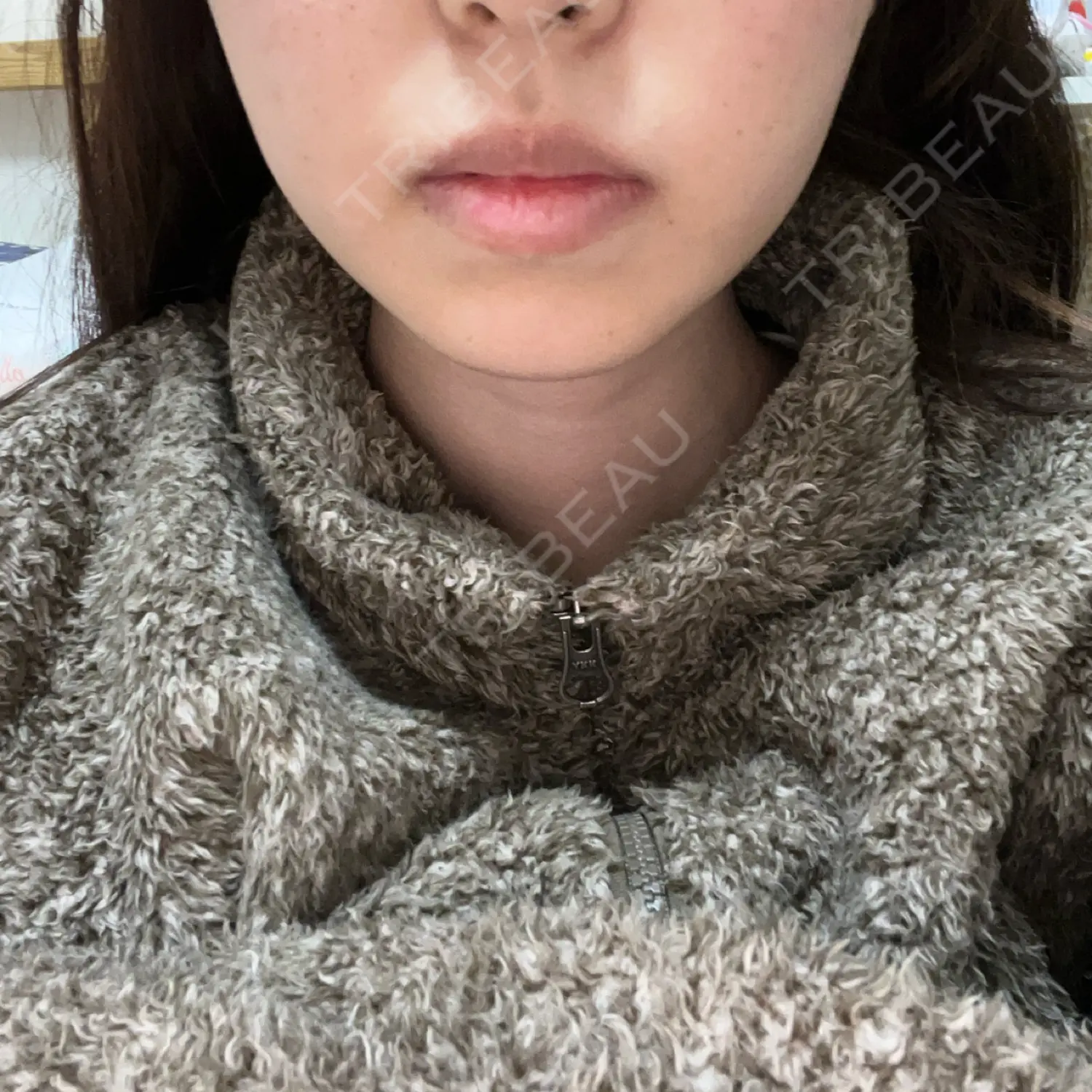 施術後の写真