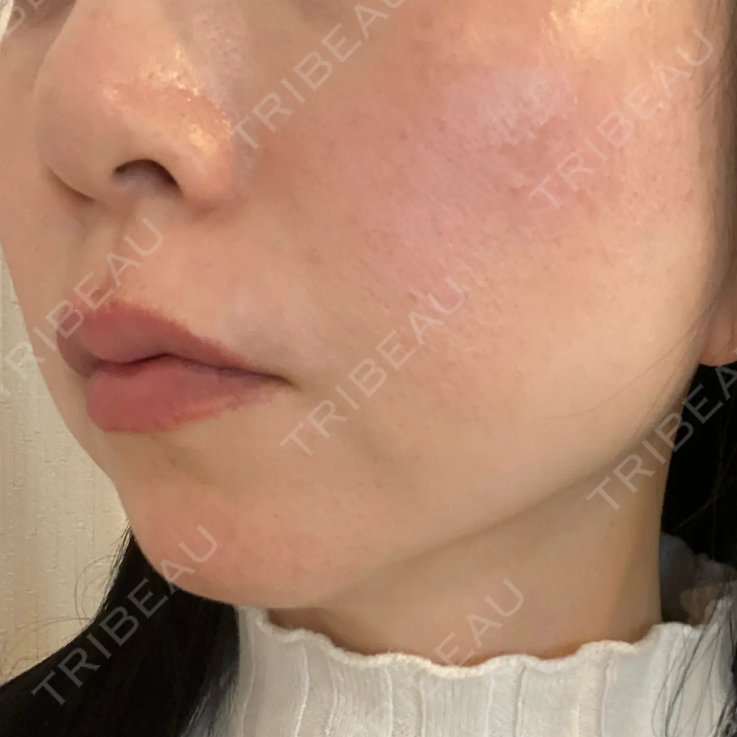 施術後の写真
