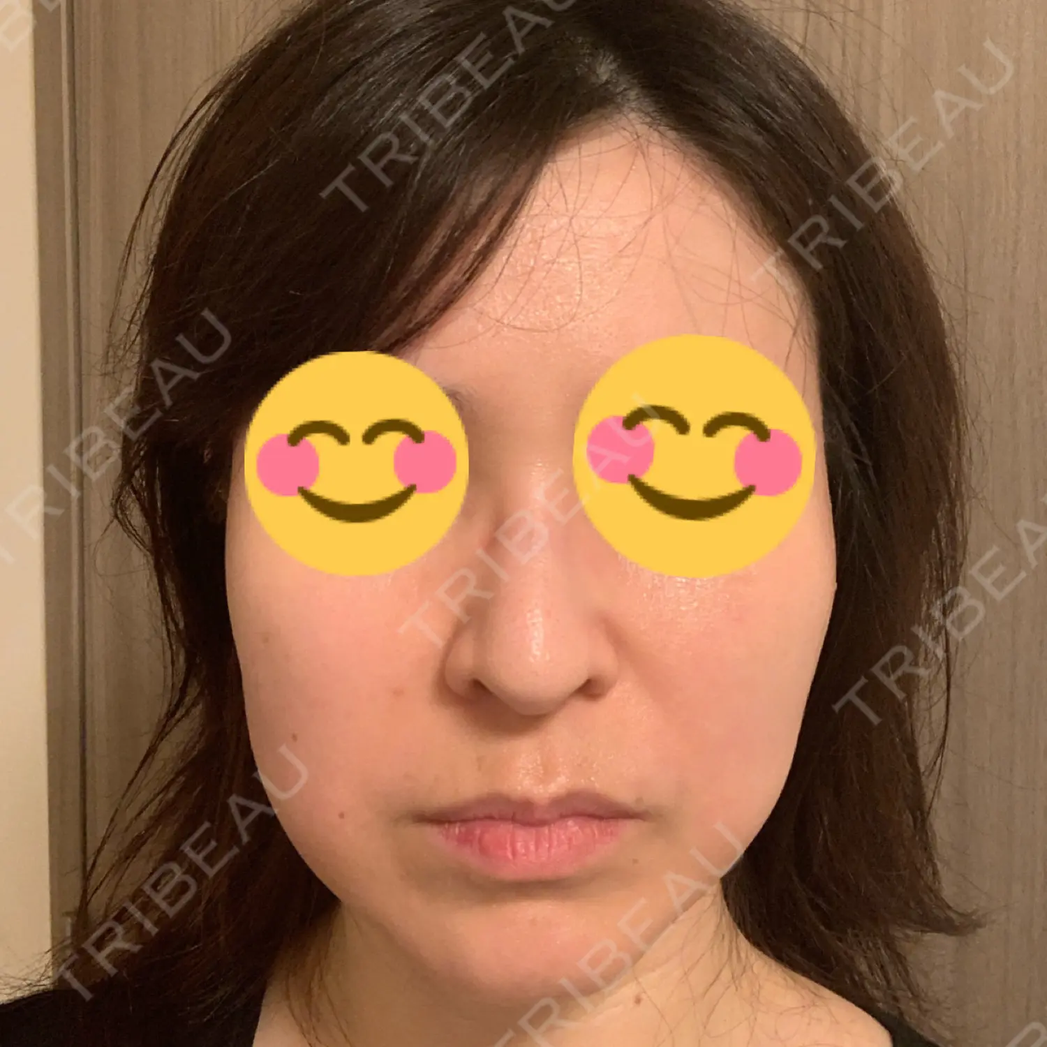 施術後の写真