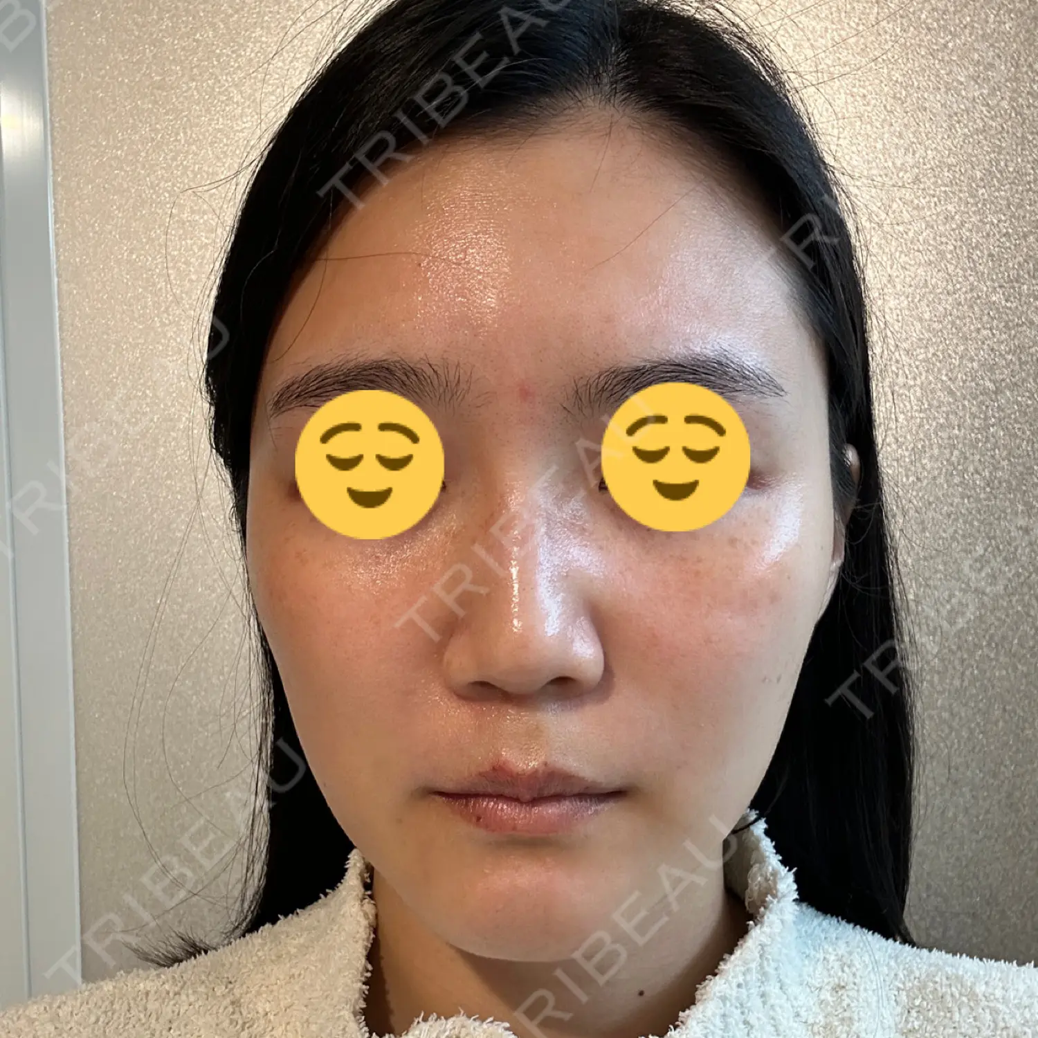 施術後の写真