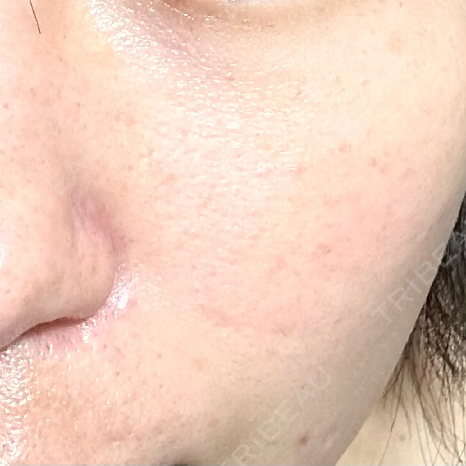 施術後の写真