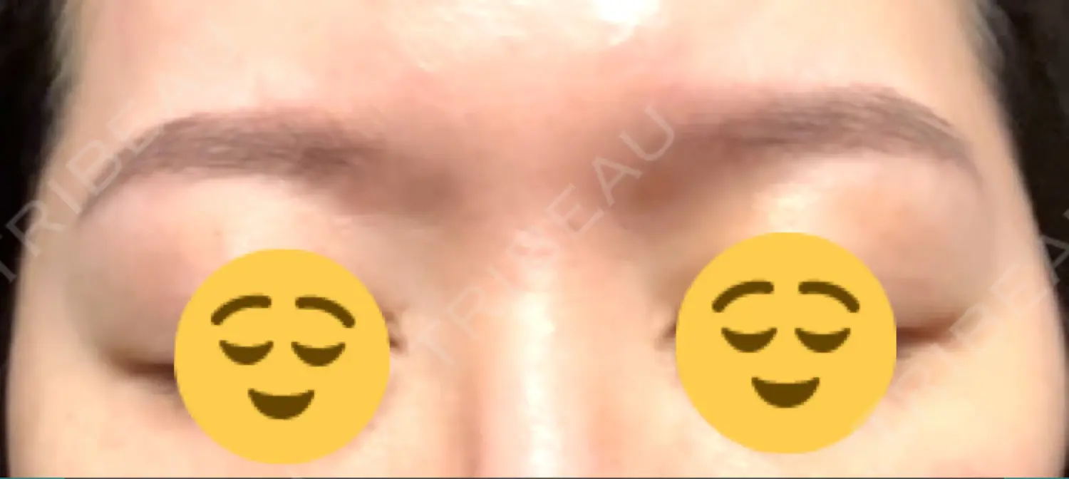 施術後の写真