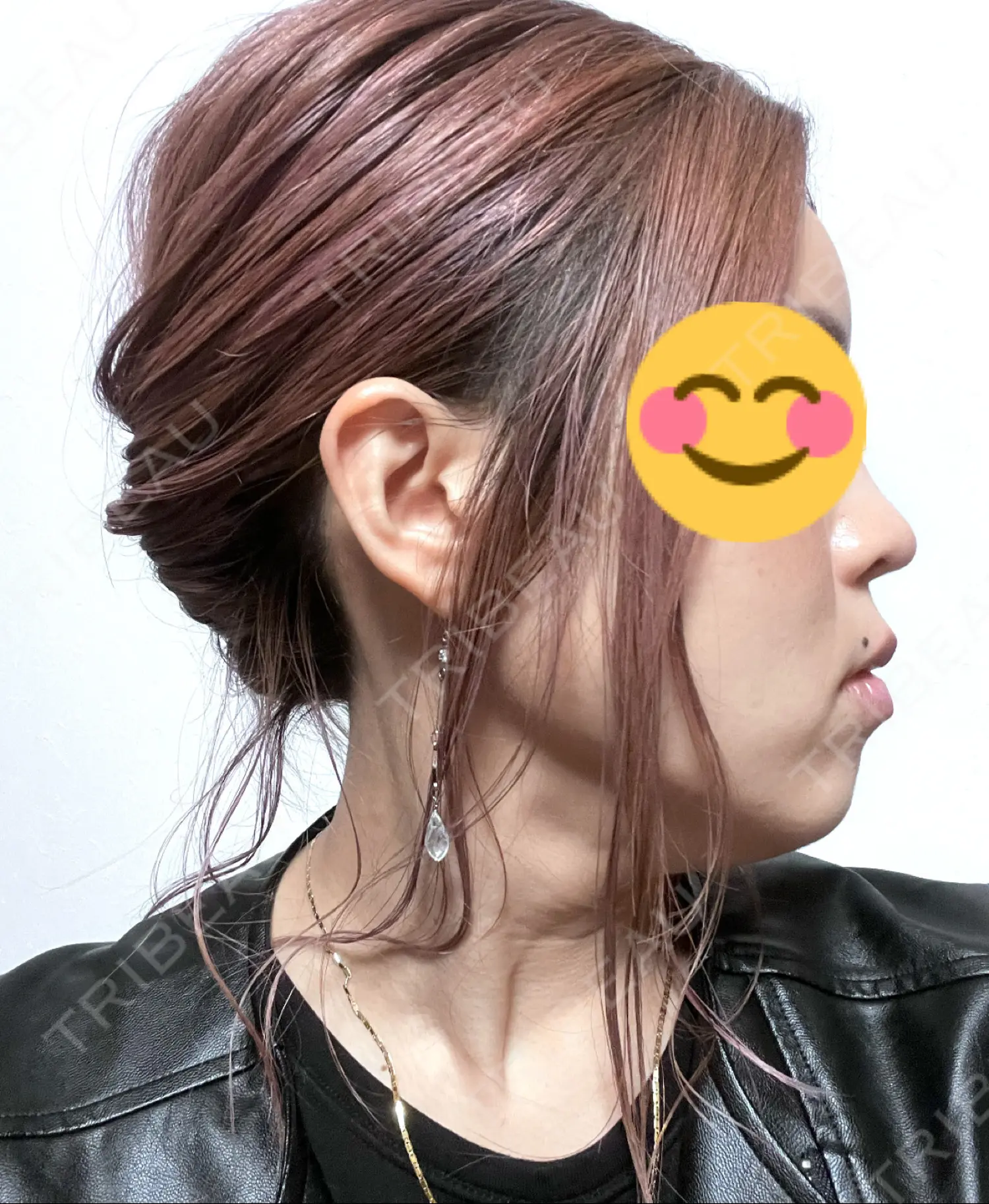施術後の写真