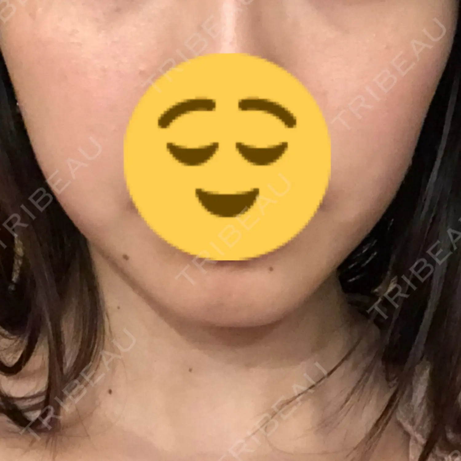 施術後の写真