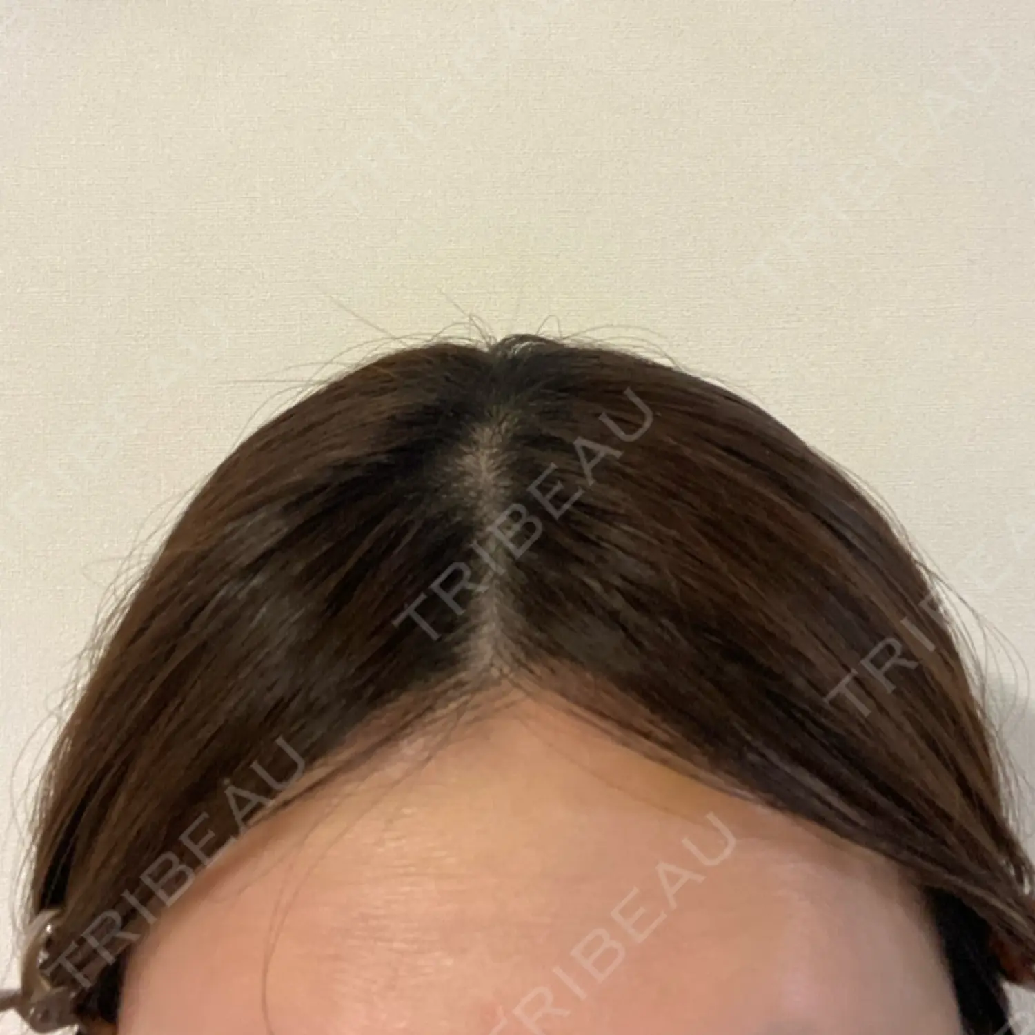 施術後の写真