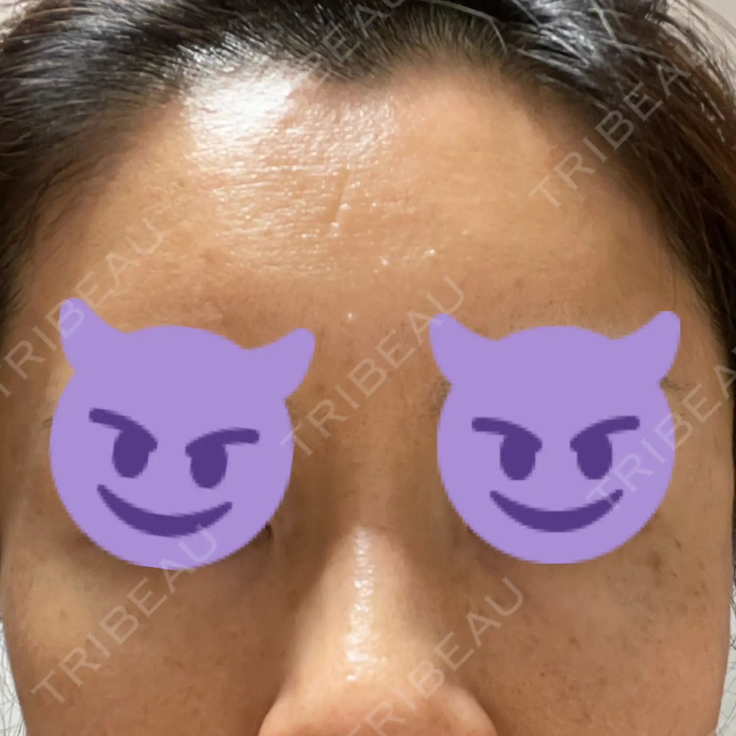 施術後の写真