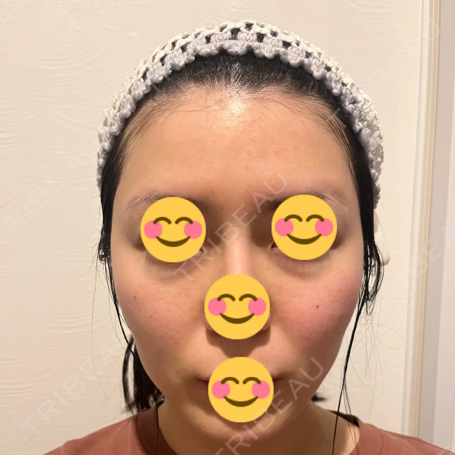施術後の写真