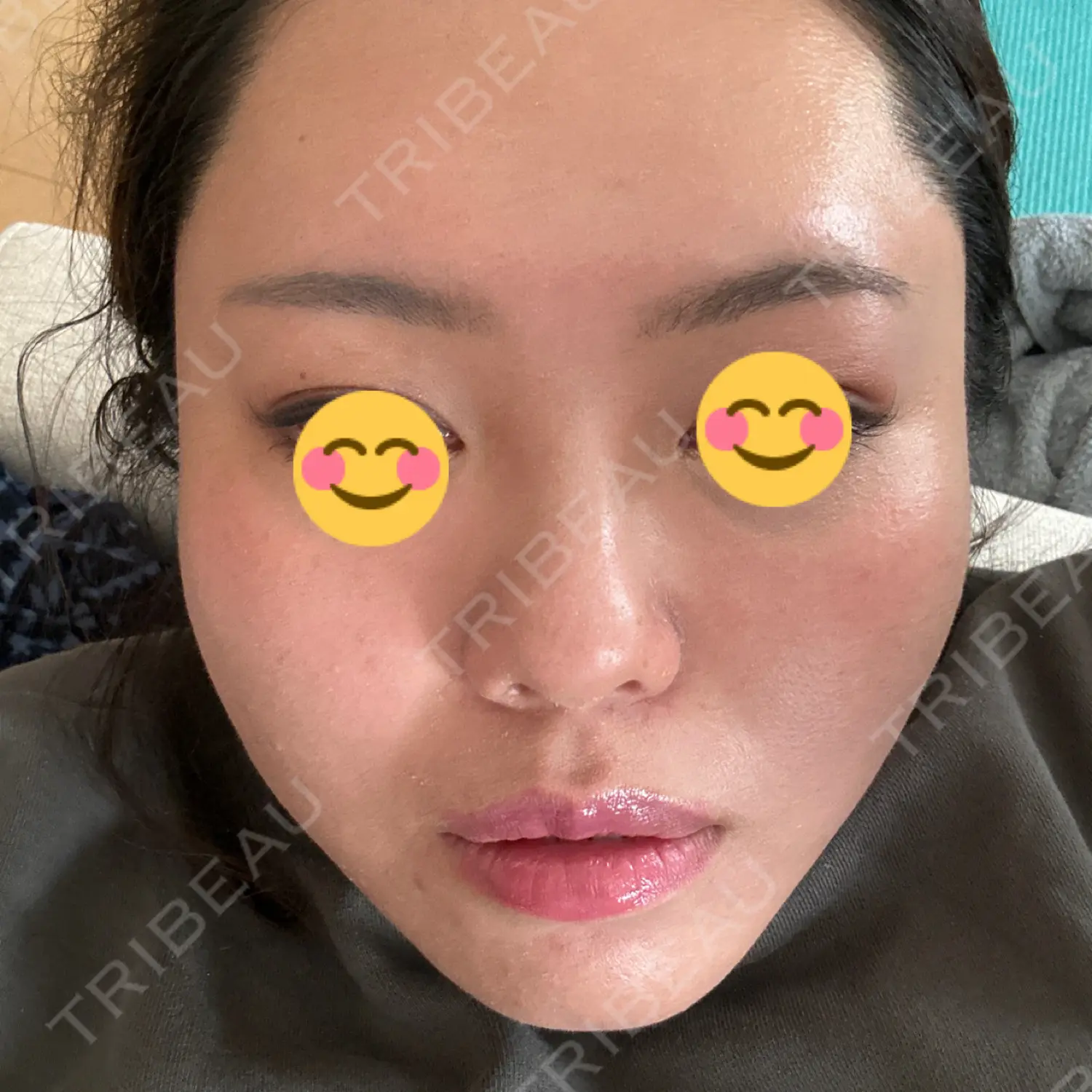 施術後の写真