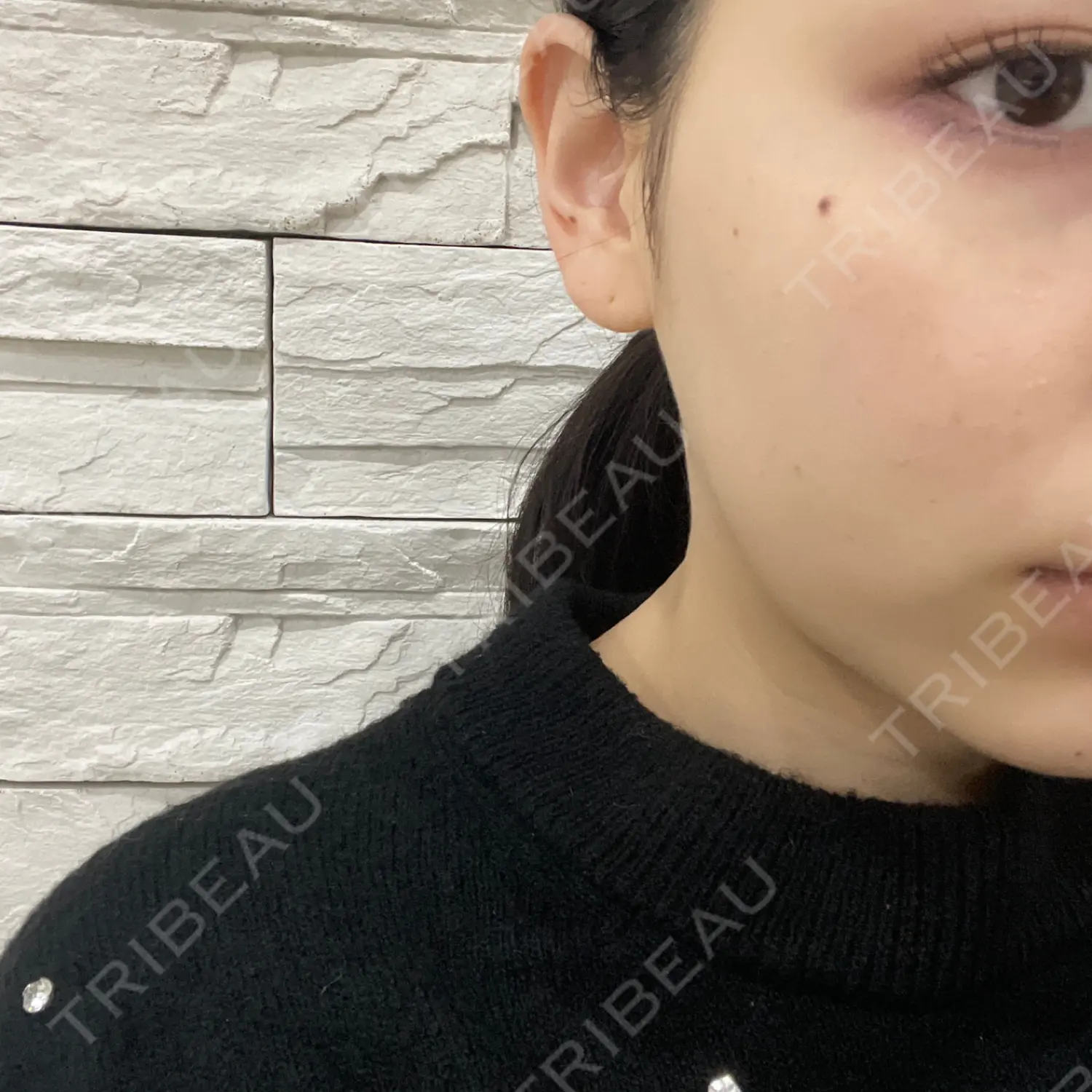 施術後の写真