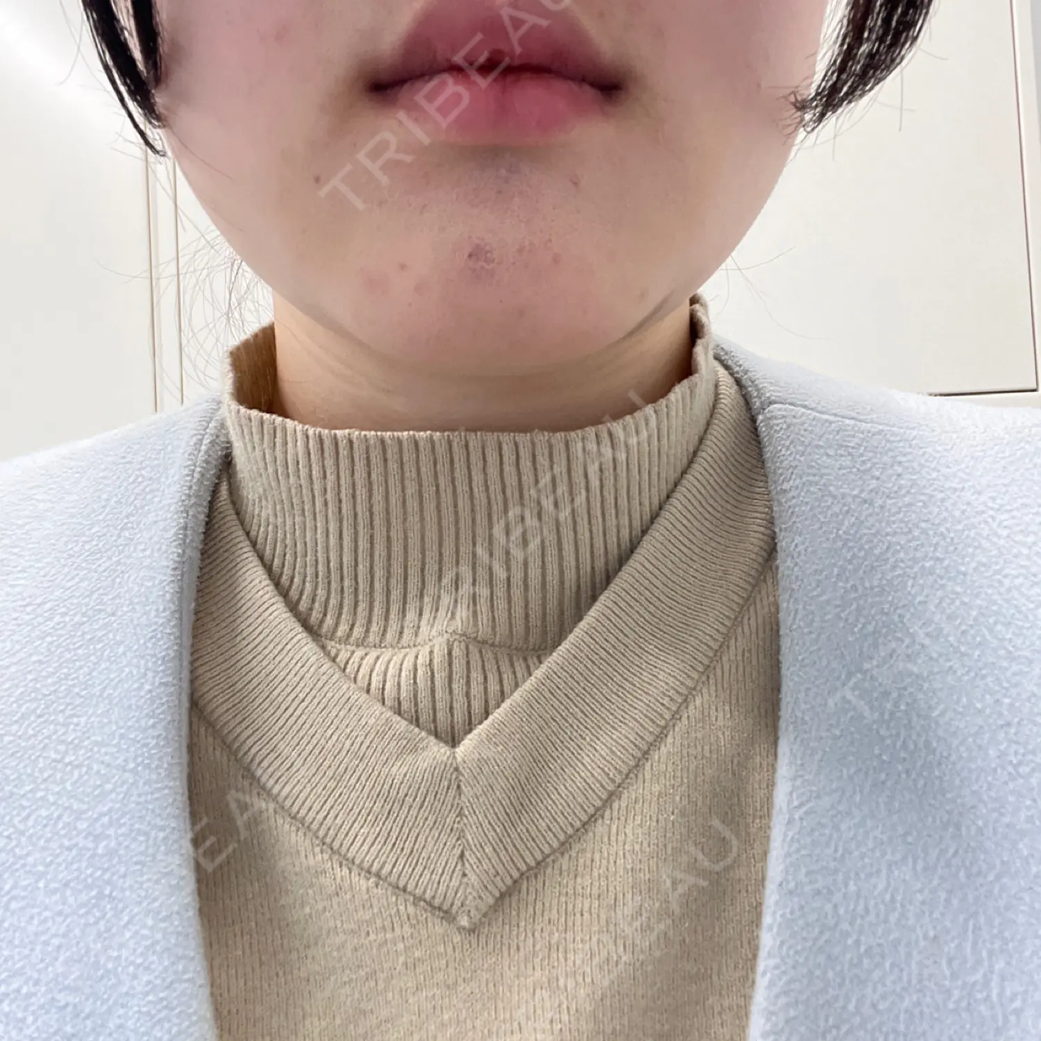 施術後の写真