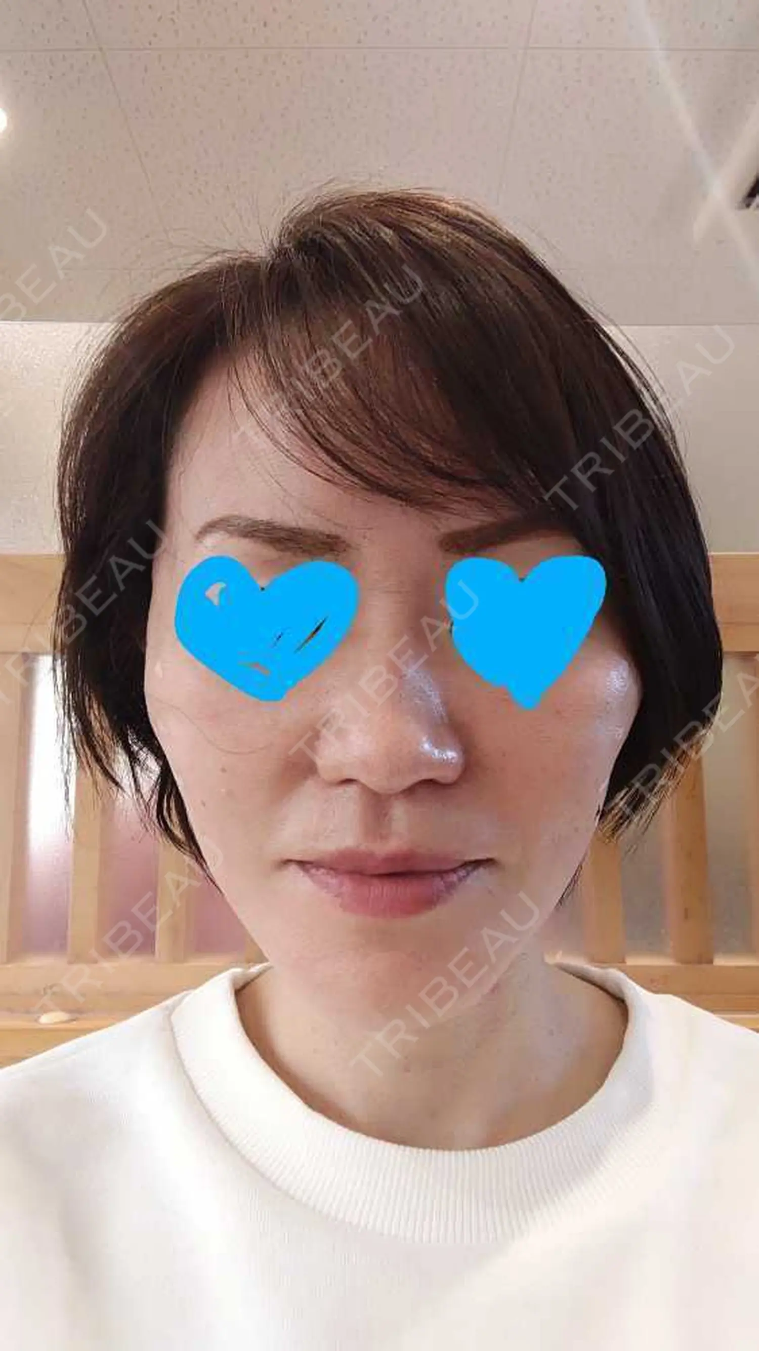 施術後の写真