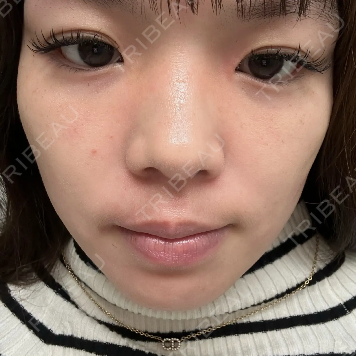 施術後の写真