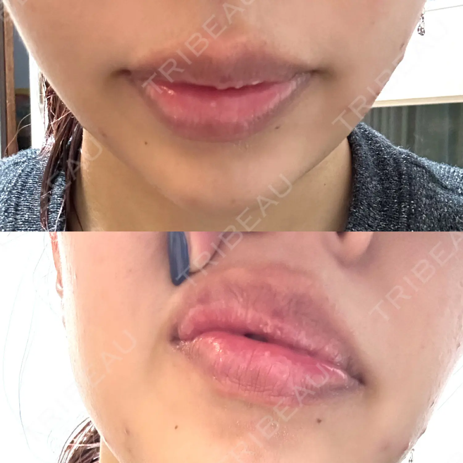 施術後の写真