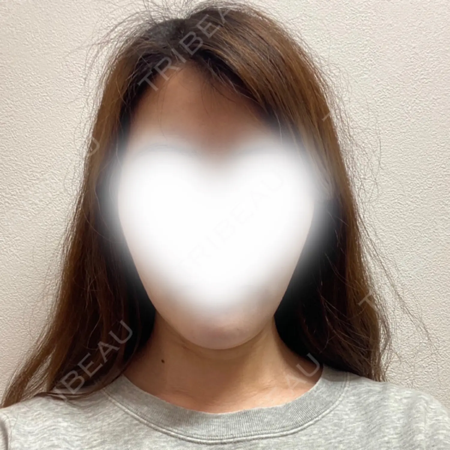 施術後の写真