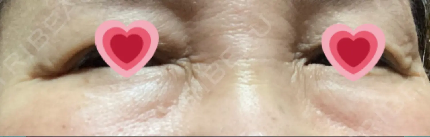 施術後の写真