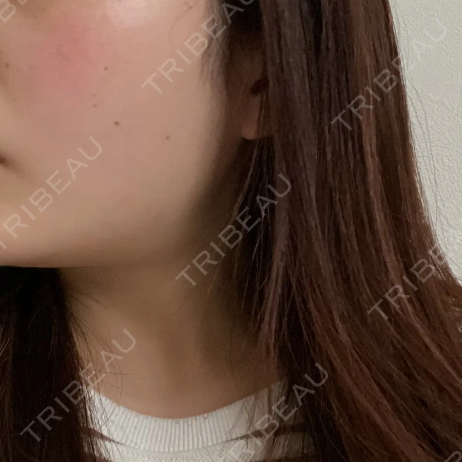 施術後の写真