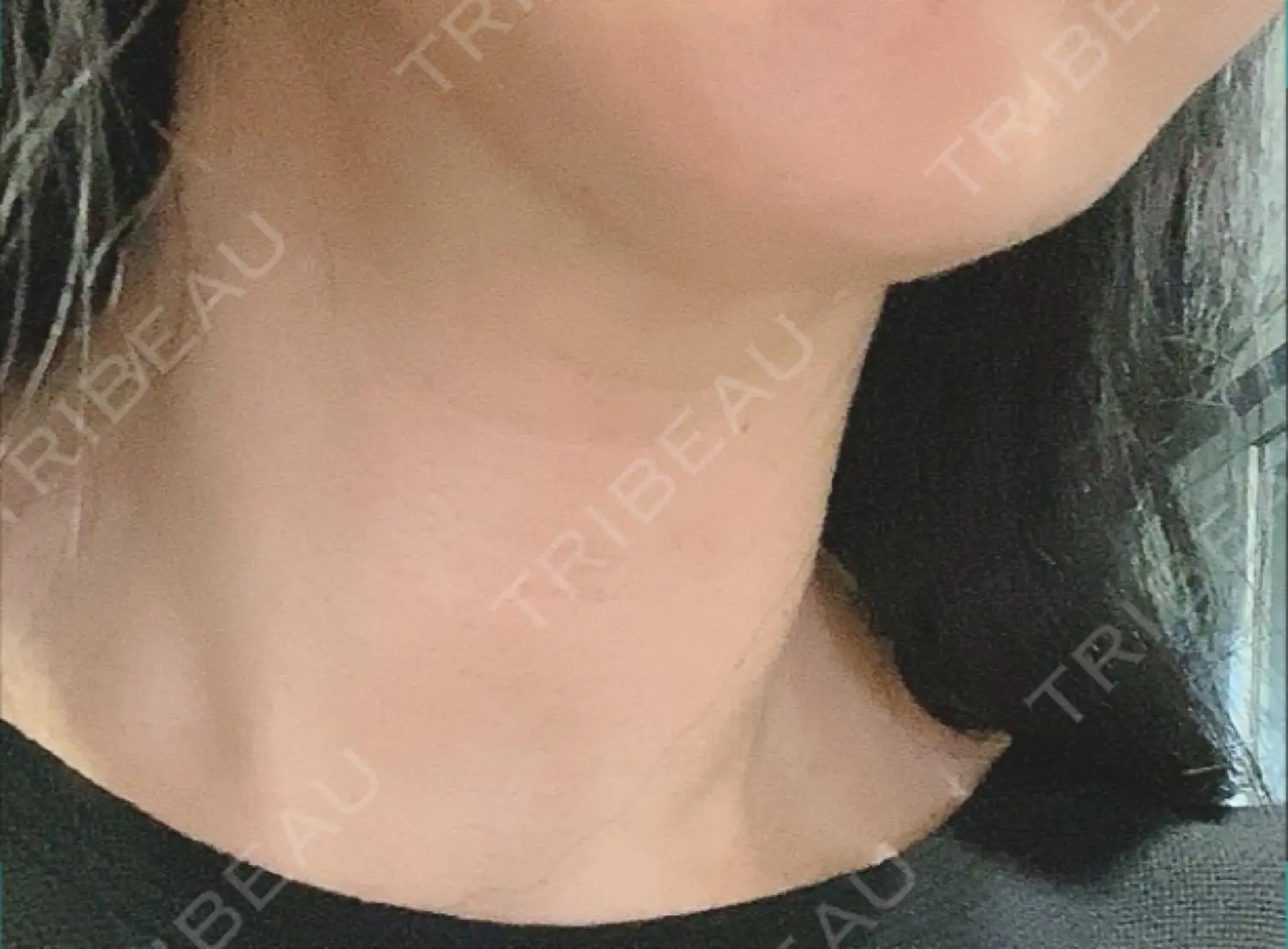 施術後の写真
