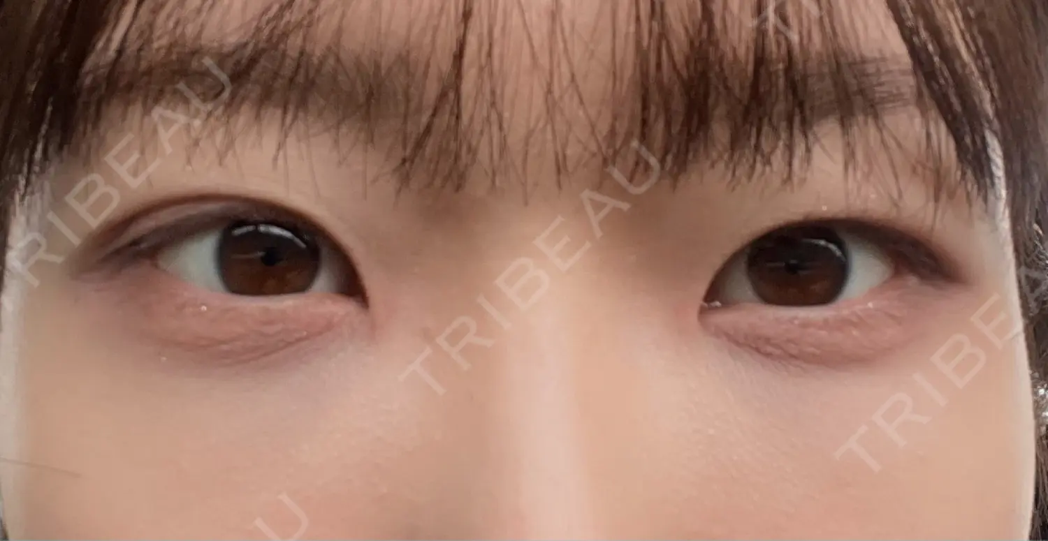 施術後の写真