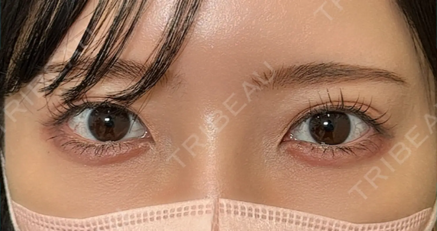 施術後の写真