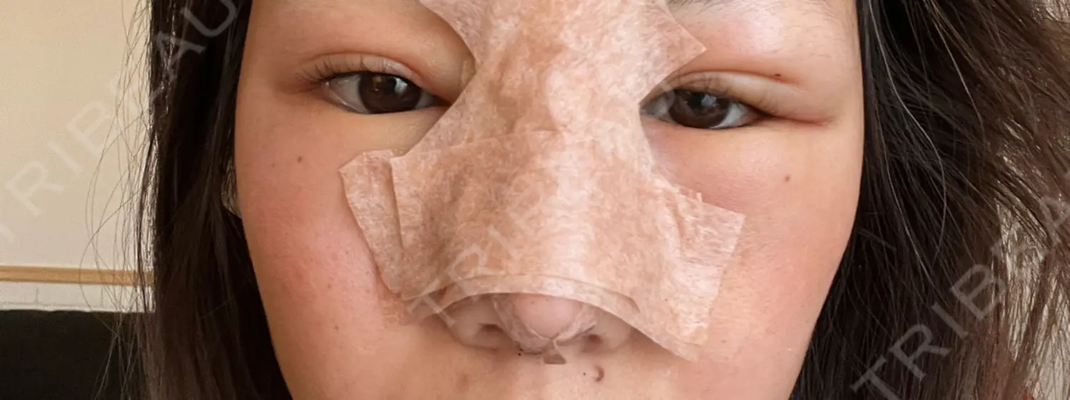 施術後の写真