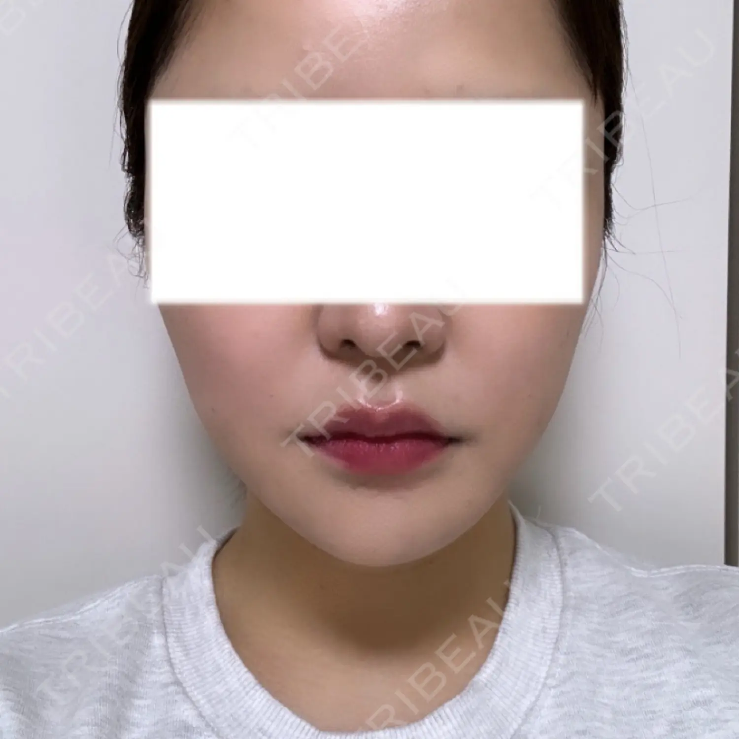 施術後の写真