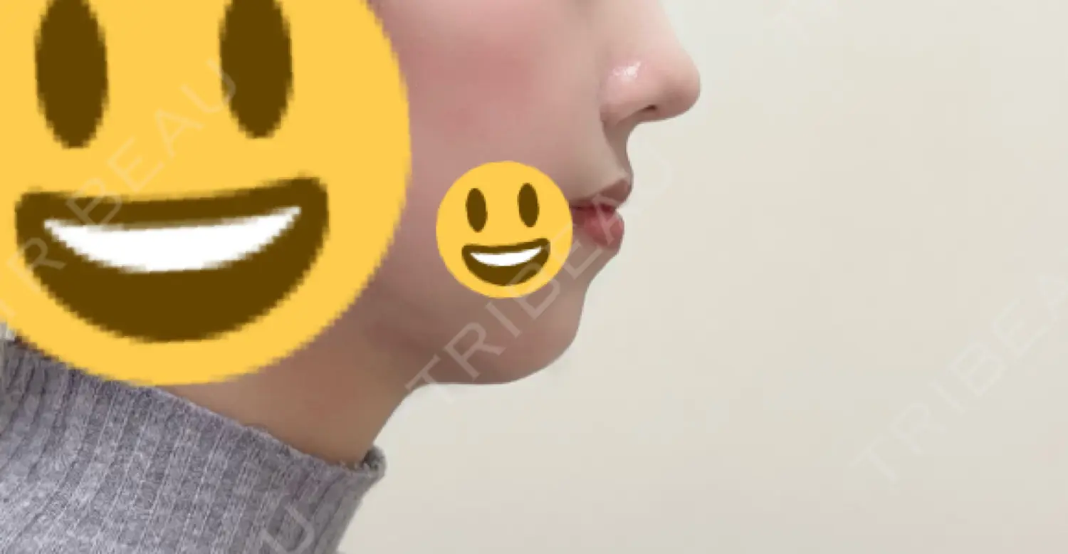 施術後の写真