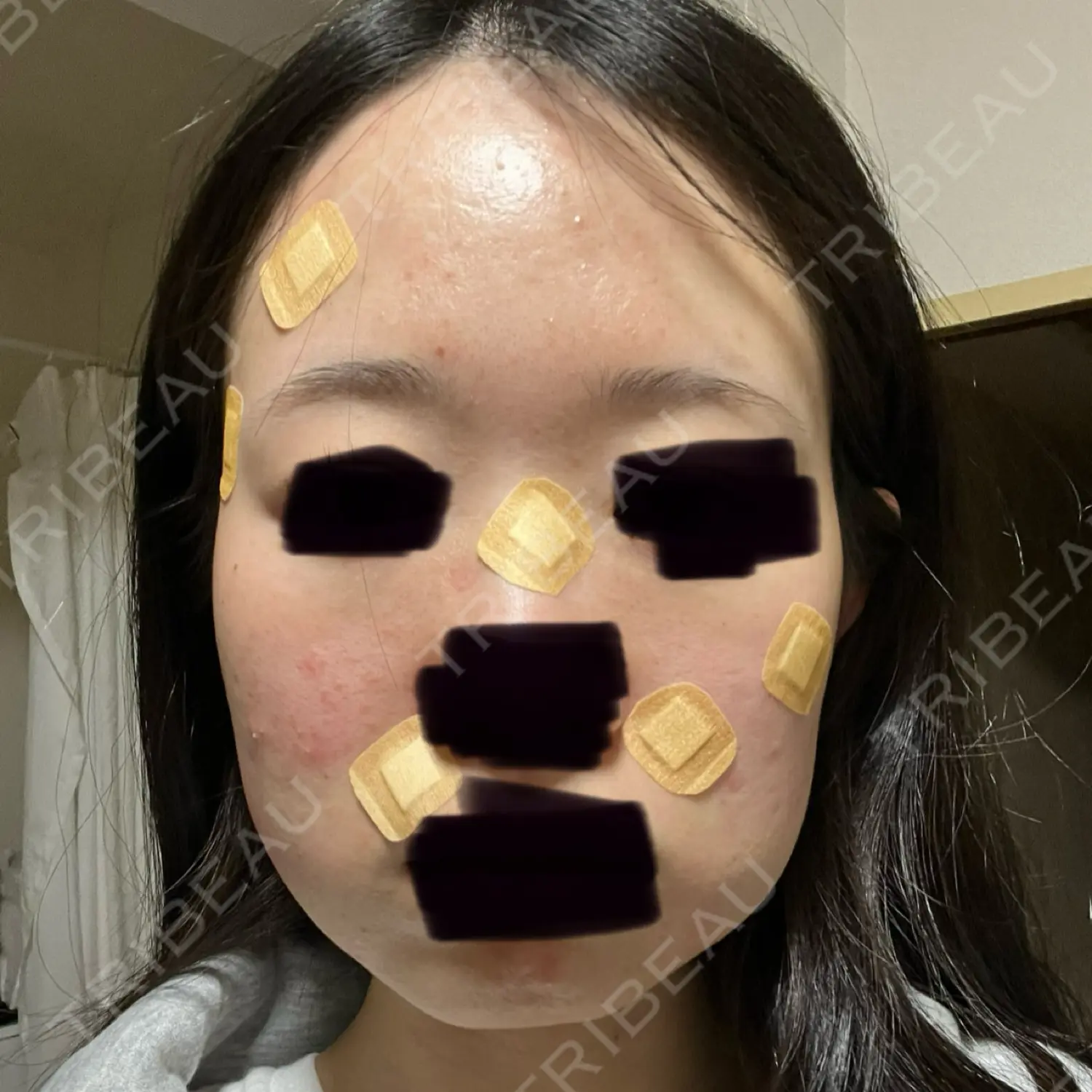 施術後の写真